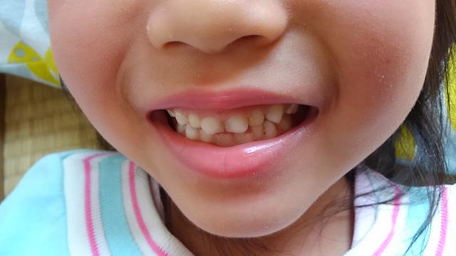 子供の出っ歯の矯正治療は早い方が良い さっぽろ矯正歯科クリニック