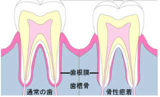 歯の根の先に癒着を認めます 